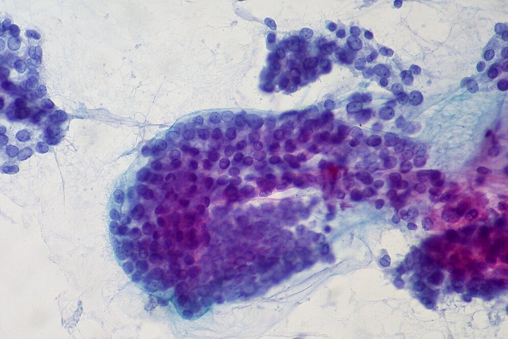 穿刺吸引細胞診で採取された甲状腺乳頭がんの細胞の顕微鏡写真
