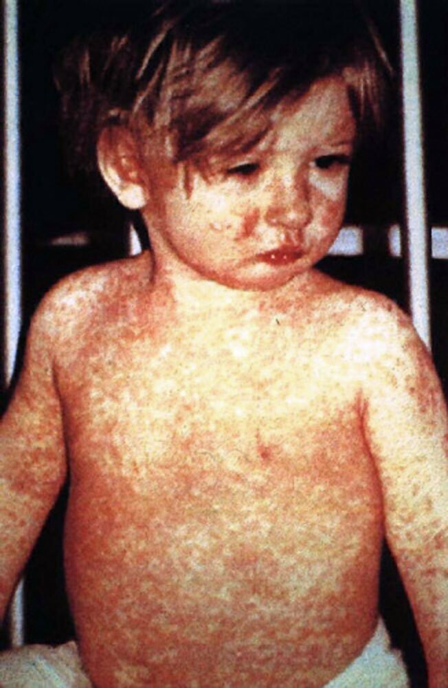 A child's face and chest covered in a red blotchy rash