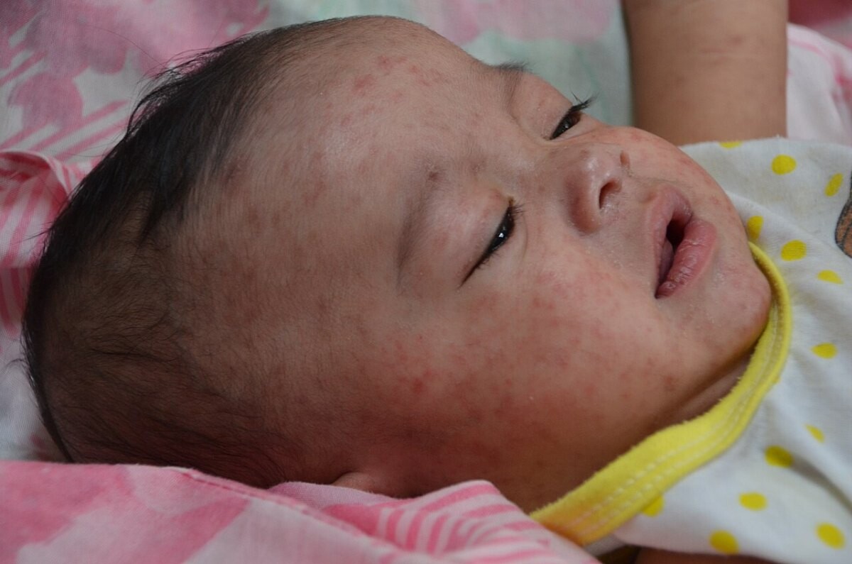 A baby with a red measles rash on the face